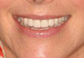 Smile Gallery - Smile 12 After 1 | Dr. James C. Ross Cosmetic & Laser Dentistry | Novi, MI